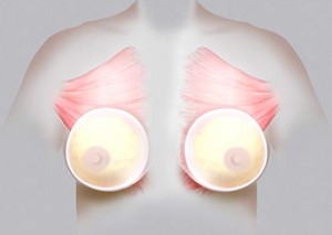 Plassering av brystimplantat foran muskelen