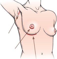Snitt & arr ved brystforstørrelse