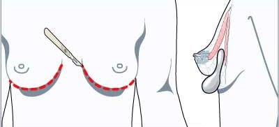 Folden under brystet vanligste snittplasseringen
