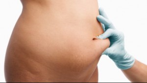 bBvirkninger og komplikasjoner ved fettsuging