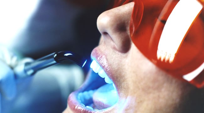 Tannbleking på klinikk