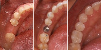 Tidlig og umiddelbar belastning på tannimplantat