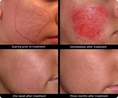 Dermabrasion hudsliping behandlinger