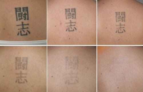 Laserfjerning av tatovering er ingen engangsbehandling