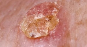 Aktiniske keratoser – en rødlig, ujevn flekk på hudoverflaten