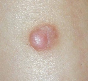 Histiocytom - flate eller opphøyde, brunrosa små hudknuter