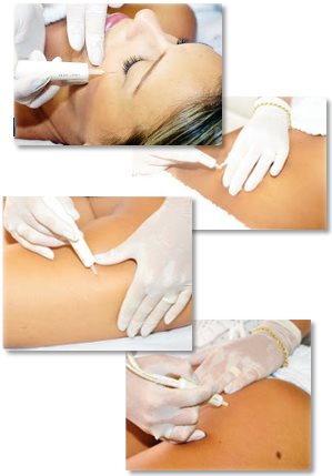 Carboxy therapy behandling