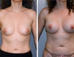 370cc-anatomiske-brystimplantat