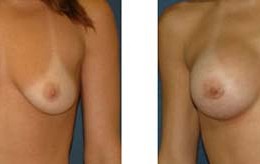 bryst-forstoerring14