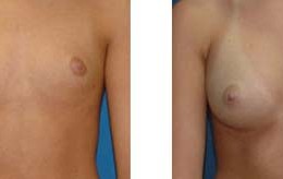 bryst-implantat23
