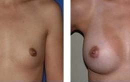 bryst-implantat24