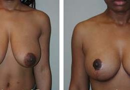 brystforminskning-9
