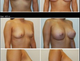 brystforstorrelse-silikon-vartgarden